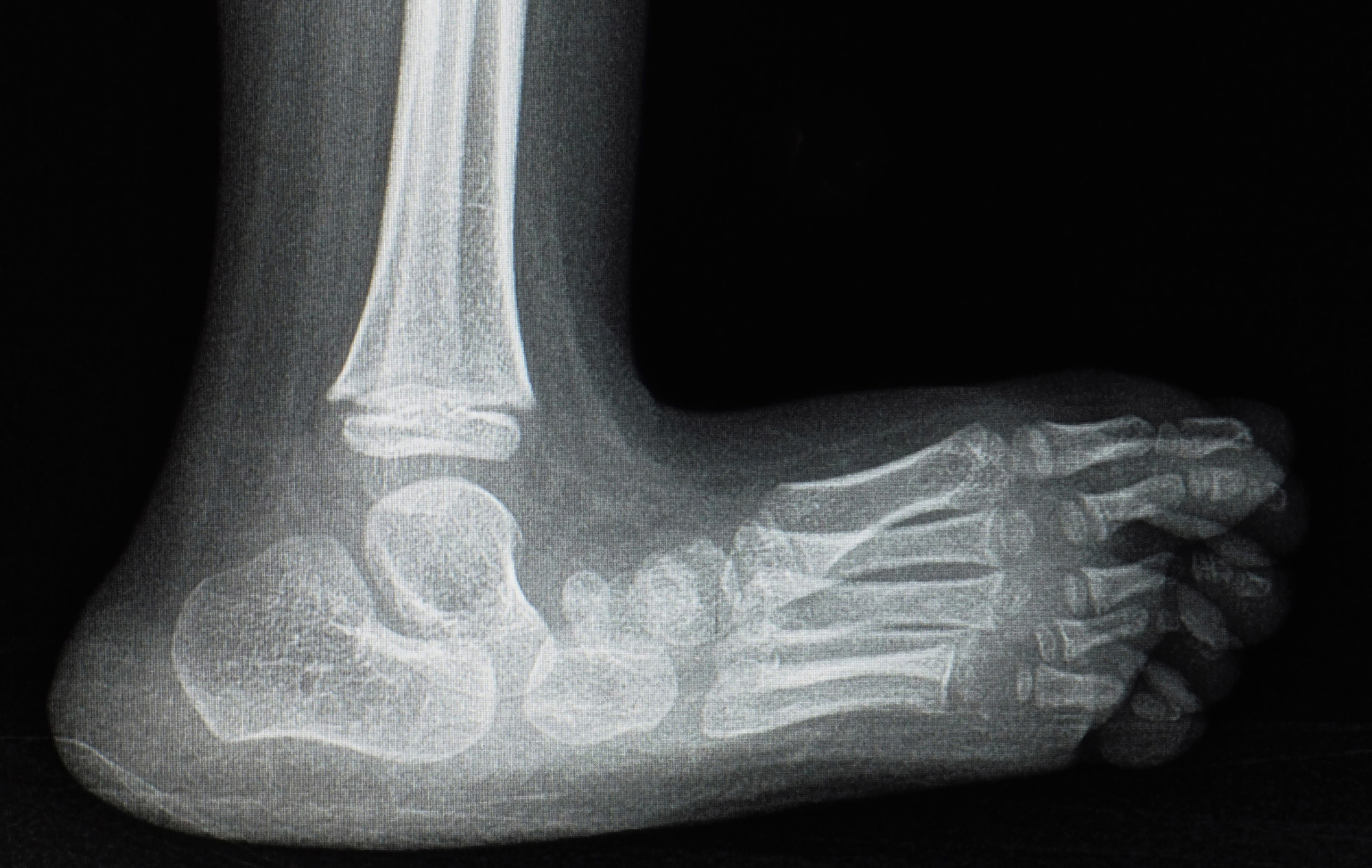 Fallen tarsal joint xray