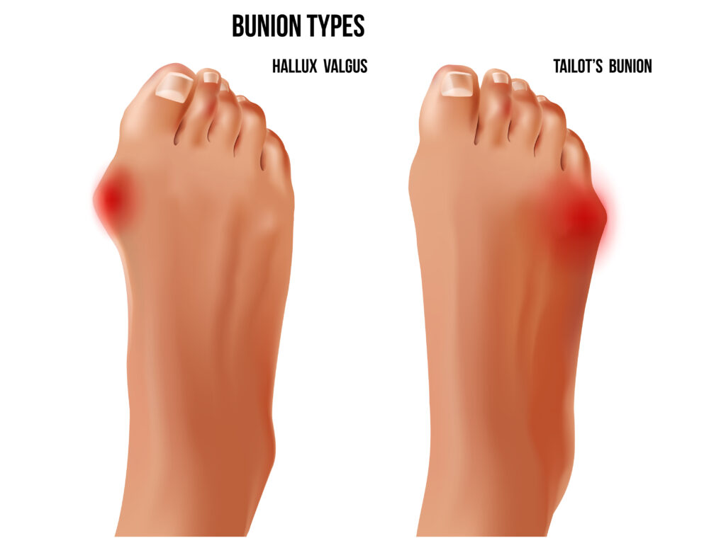 Bunions